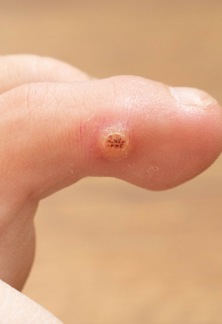 wart after virus